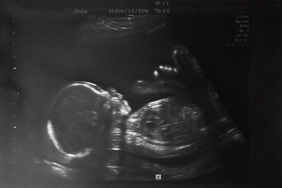 Foetal-anatomy-scan